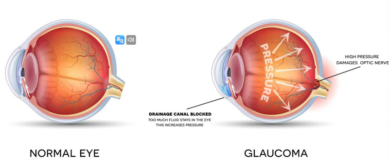 understanding normal eye pressure range